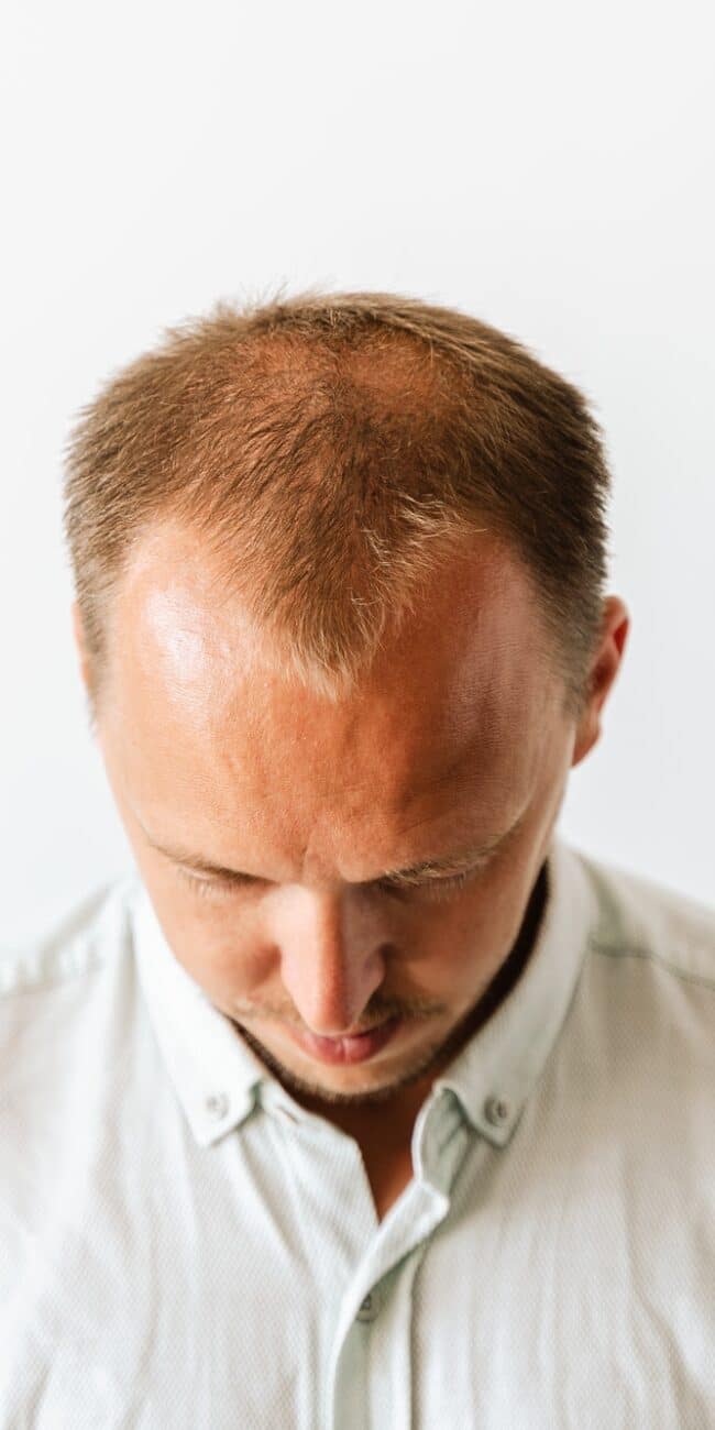 Before hair transplantation. Young bald man with hair loss problems. White background with copy