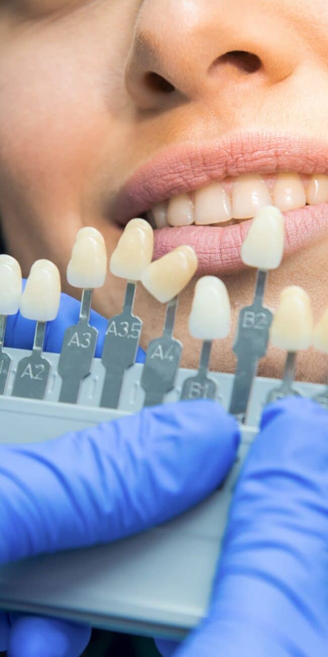 Tooth whitening chart